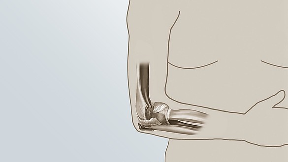 Resultados iniciais promissores com a embolização no tratamento do “cotovelo de tenista” são apresentados no SIR 2019
